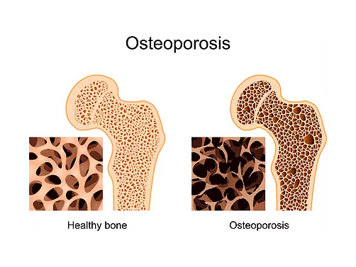 osteoporosis