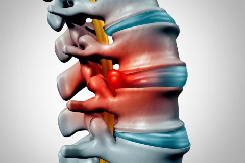 hernia discal