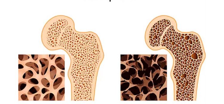 osteoporosis