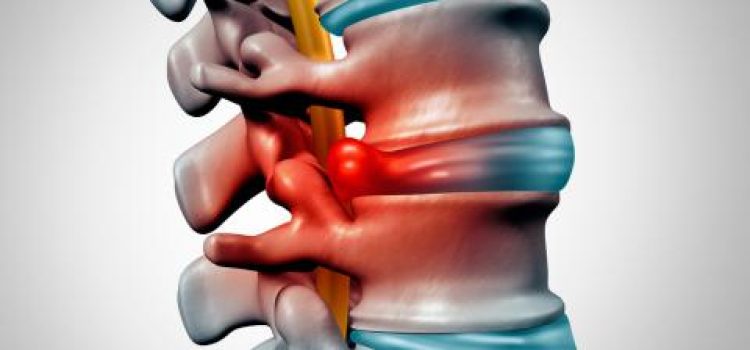 hernia discal